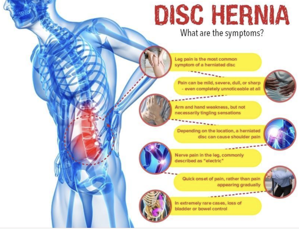 3 Signs You May Have a Slipped Disc