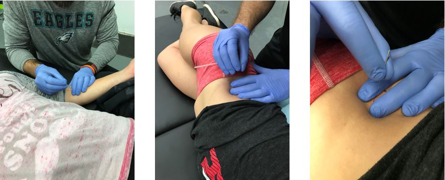 What is Dry Needling & How Can It Benefit You?